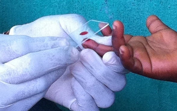 Due mani protette da guanti bianchi in lattice prelevano un campione di sangue dal dito di un bambino.